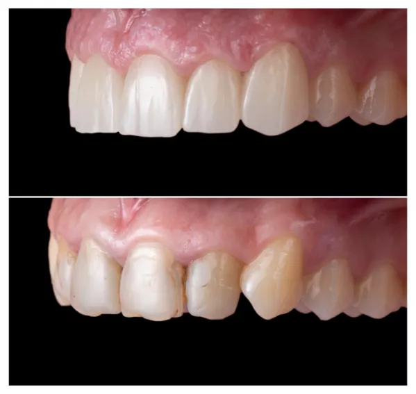 Uzupełnienia protetyczne z materiału IPS E- Max Ivoclar - poprawa kształtu i wzmocnienie zębów z wieloma wypełnieniami