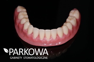 proteza na implantach na zatrzaskach 2