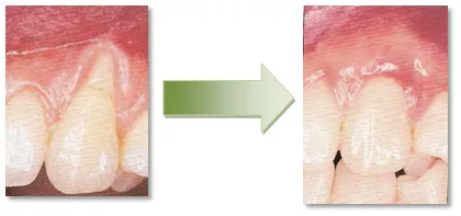 Dobry dentysta Stargard dobry stomatolog Stargard Szczeciński. Wybielanie zębów Stargard