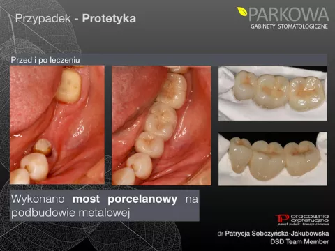 Do czego służą mosty protetyczne?