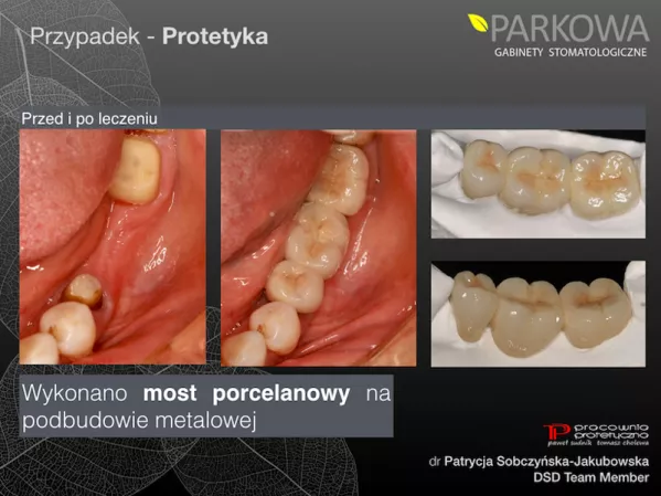 Do czego służą mosty protetyczne?