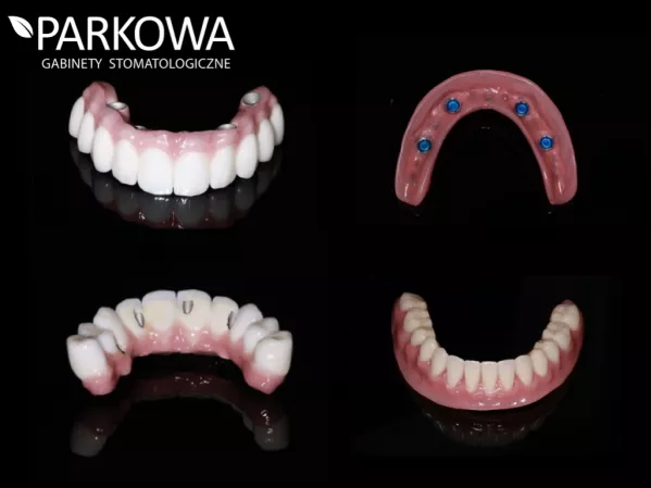 Most okrężny na implantach - odzyskaj radość gryzienia !