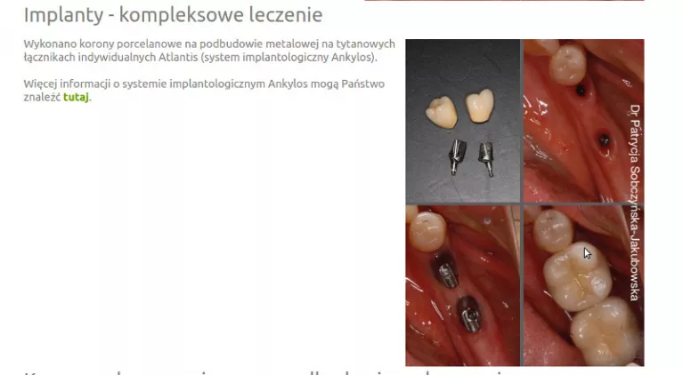 Co to są protezy overdenture?