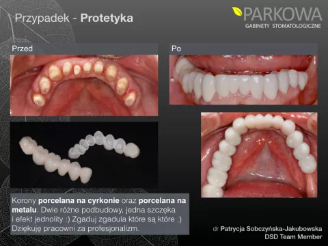 Korony porcelanowe, cyrkonowe, na podbudowie metalowej - czyli koronowy zawrót głowy