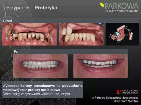 Na czym polega zabieg szynowania zębów?