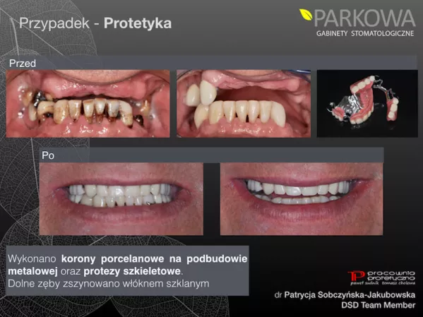 Na czym polega zabieg szynowania zębów?