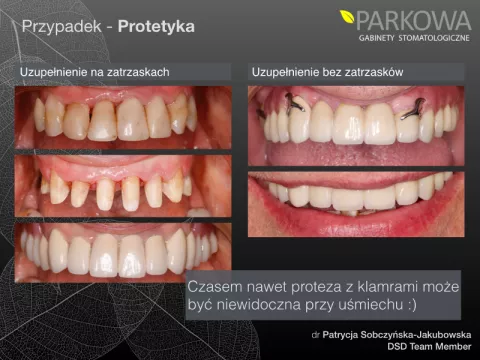 Protezy szkieletowe - klamrowe i bezklamrowe