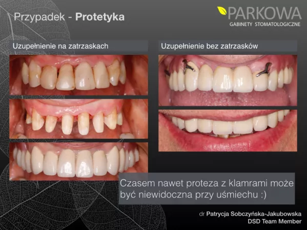Protezy szkieletowe - klamrowe i bezklamrowe