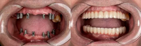 Protezy typu overdenture w gabinecie Parkowa