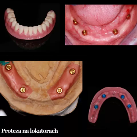 Protezy na lokatorach (rodzaj protez wykonywanych na 4 implantach)