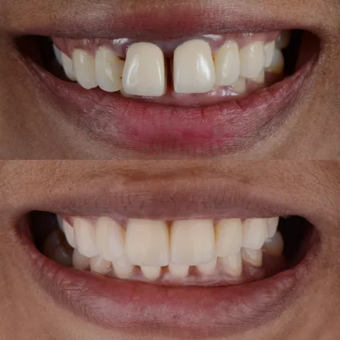Diastema - jak można ją zamknąć?