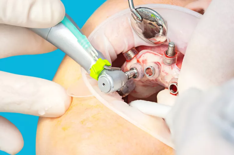 Zabiegi implantacji z szablonem chirurgicznym