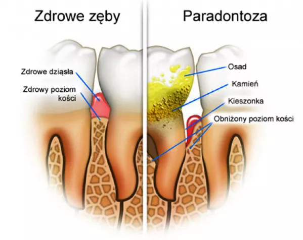 Przewlekłe zapalenie przyzębia: Sposoby na walkę z paradontozą