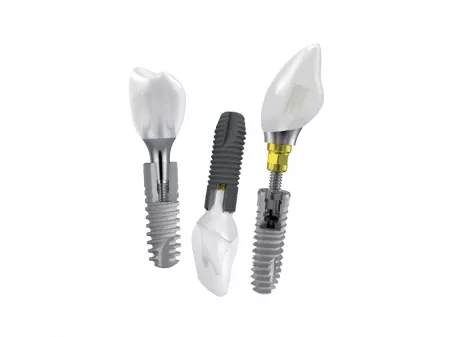 Czym są implanty zębowe? 