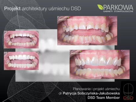 DSD – cyfrowe projektowanie uśmiechu 