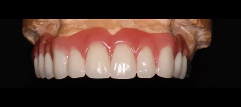 Proteza zębowa 