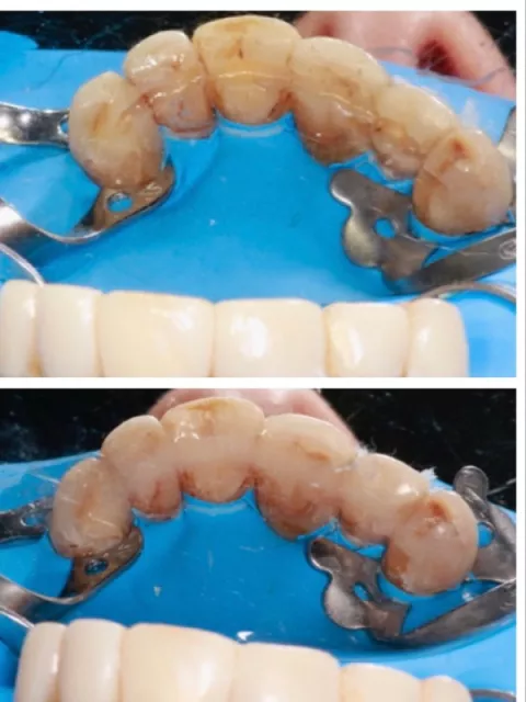 Szynowanie rozchwianych zębów włóknem szklanym - przedłużenie posiadania własnego uzębienia