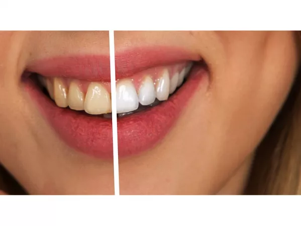 Wybielanie zębów w gabinecie stomatologicznym