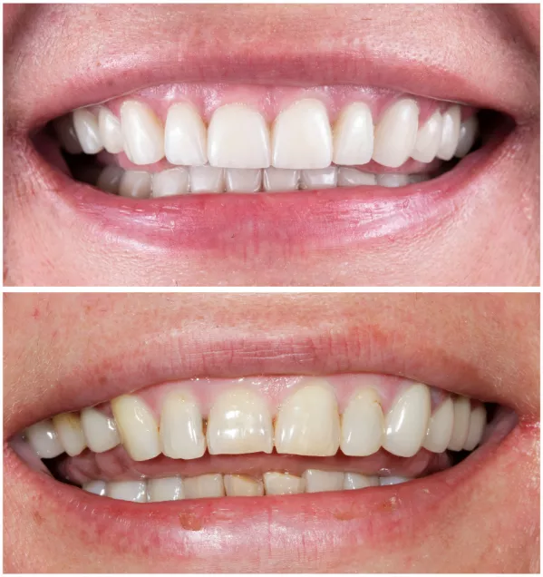 Bonding zębów - rewolucja w szybkiej estetyce uśmiechu!