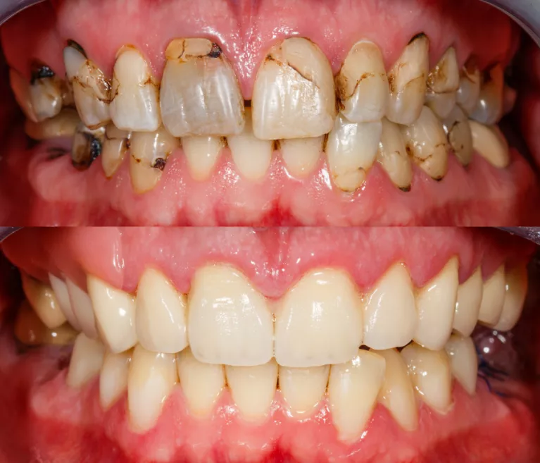Kompozytowe odbudowy zębów to wstęp do poprawy uśmiechu i przywrócenia zdrowia jamie ustnej