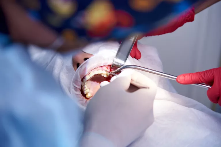 Odbudowa kości: Sinus Lift w świetle stomatologii